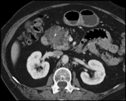 Cystadenoma of the Pancreas - CTisus CT Scan