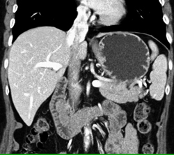 Ampullary Cancer - CTisus CT Scan