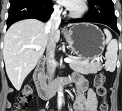 Ampullary Cancer - CTisus CT Scan