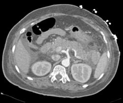 Acute Pancreatitis - CTisus CT Scan