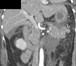 Acute Pancreatitis - CTisus CT Scan