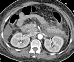 Acute Pancreatitis - CTisus CT Scan