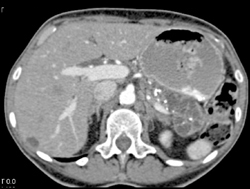 Intraductal Papillary Mucinous Neoplasm (IPMN) Involves the Entire Gland With Dilated Pancreatic Duct - CTisus CT Scan