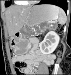 Chronic Pancreatitis - CTisus CT Scan