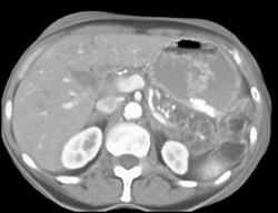 Chronic Pancreatitis - CTisus CT Scan