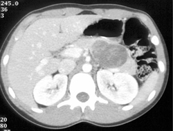 Hamoudi Tumor- SPEN - CTisus CT Scan