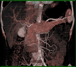 Normal VRT of the Pancreas - CTisus CT Scan