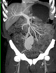 Carcinoid Encases Portal Vein (PV) - CTisus CT Scan