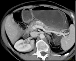 Varices Around Pancreatic Head Simulate A Mass - CTisus CT Scan