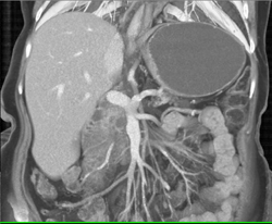 Pancreatic Adenocarcinoma - CTisus CT Scan