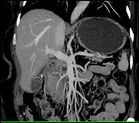 Pancreatic Adenocarcinoma - CTisus CT Scan