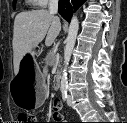 Pancreatic Cancer Involves the Celiac Axis - CTisus CT Scan