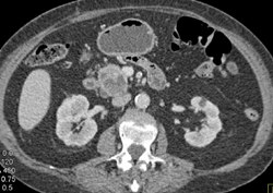 Cystic Pancreatic Cancer - CTisus CT Scan