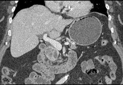 Pancreatic Adenocarcinoma - CTisus CT Scan