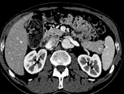 5 Mm Insulinoma in Tail of Pancreas - CTisus CT Scan