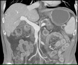 Multiple Intraductal Papillary Mucinous Neoplasms (IPMNs) - CTisus CT Scan