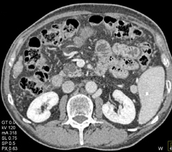 Multiple Intraductal Papillary Mucinous Neoplasms (IPMNs) - CTisus CT Scan