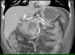 Pancreatic Cancer - CTisus CT Scan