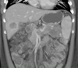 Adenocarcinoma of the Pancreas With Liver Metastases - CTisus CT Scan