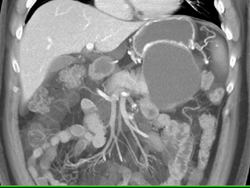 Cystadenoma - CTisus CT Scan