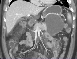 Cystadenoma - CTisus CT Scan