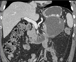 Cystadenoma - CTisus CT Scan