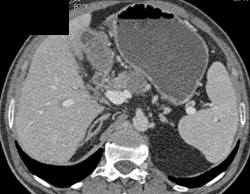 Carcinoma of the Body of the Pancreas With Carcinomatosis - CTisus CT Scan