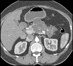 Cystadenoma - CTisus CT Scan