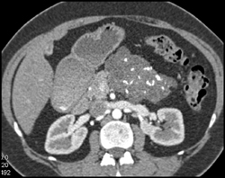 Cystadenoma - CTisus CT Scan