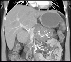 Cystadenoma - CTisus CT Scan