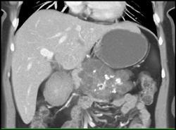 Cystadenoma - CTisus CT Scan