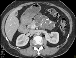 Cystadenoma - CTisus CT Scan