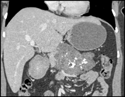 Cystadenoma - CTisus CT Scan