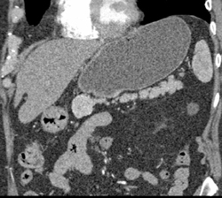 Normal Pancreatic Tail - CTisus CT Scan