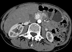 Insulinoma - CTisus CT Scan