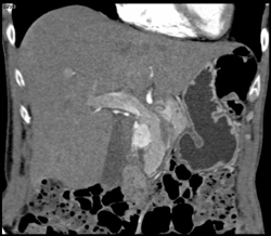 Insulinoma - CTisus CT Scan