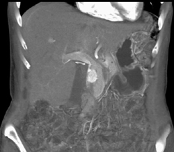 Insulinoma - CTisus CT Scan