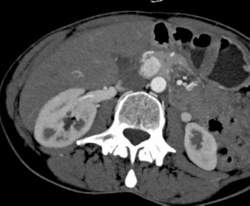 Insulinoma - CTisus CT Scan