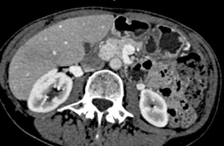 Insulinoma - CTisus CT Scan