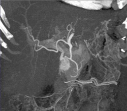 Insulinoma - CTisus CT Scan