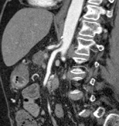 Narrowing of SMA Celiac Artery Due to Median Arcuate Ligament Syndrome - CTisus CT Scan