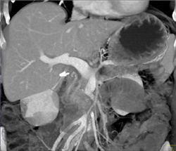 Notch in Portal Vein - CTisus CT Scan