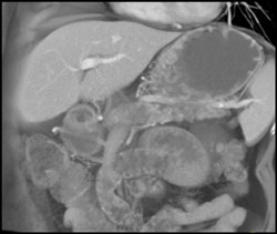 Pancreatic Adenocarcinoma - CTisus CT Scan