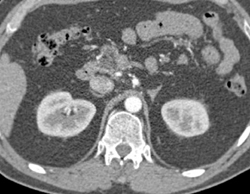 Pancreatic Adenocarcinoma - CTisus CT Scan