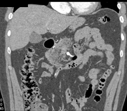 Pancreatic Adenocarcinoma - CTisus CT Scan