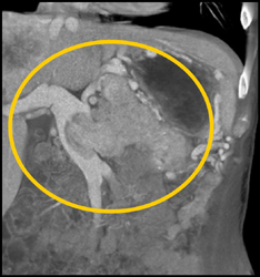 Pancreatic Tumor Directly Invades the Portal Vein - CTisus CT Scan