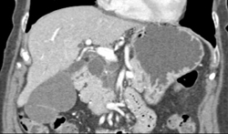 Cystadenoma - CTisus CT Scan