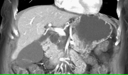 Cystadenoma - CTisus CT Scan