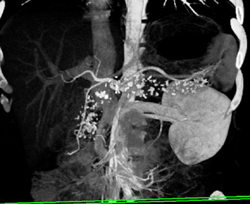 Chronic Pancreatitis - CTisus CT Scan