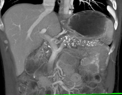 Chronic Pancreatitis - CTisus CT Scan